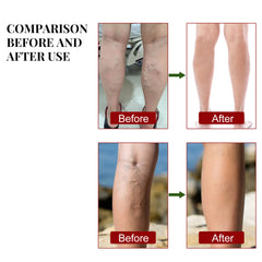 South Moon Herbal Patches for Leg Pain Relief